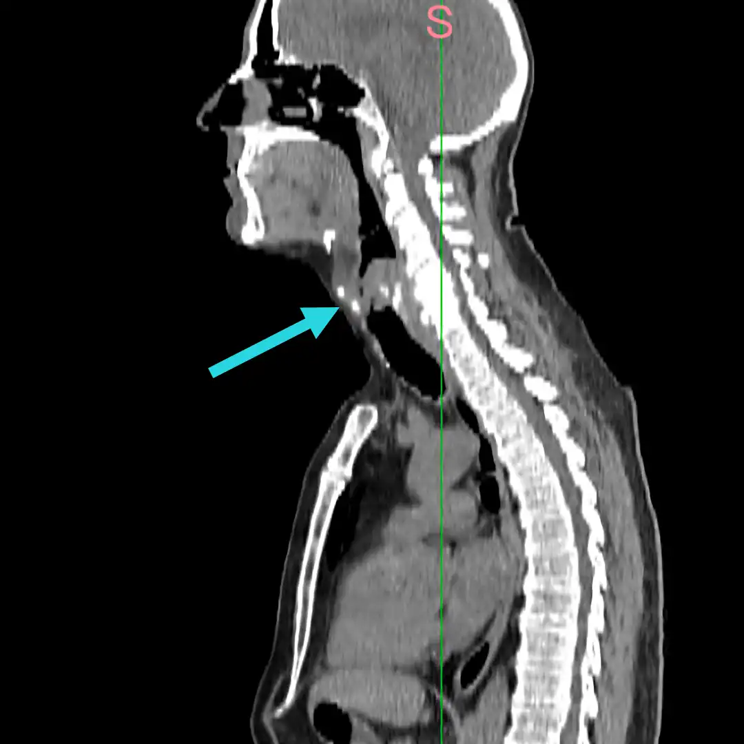 Larynx Carcinoma PET Image